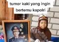 Kapolri Merespons Permintaan Sinta Aulia, Anak Penderita Tumor Kaki